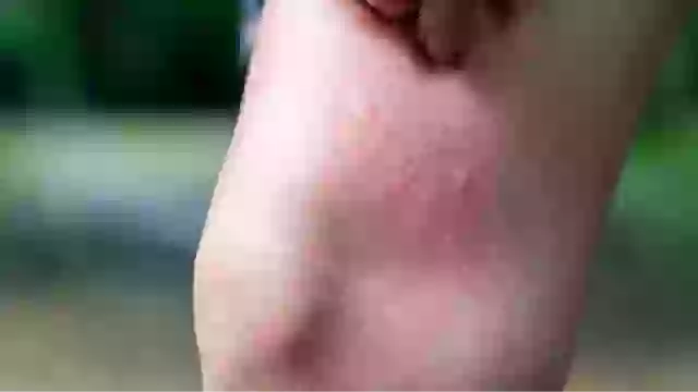 Mom, 33, issues warning after noticing ‘mosquito bite’ that turned out to be much more sinister.