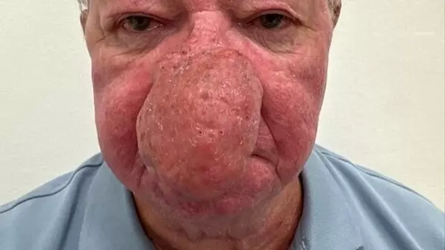 Man unable to kiss wife after one of the ‘worst cases’ of nose growth doctors have ever seen.