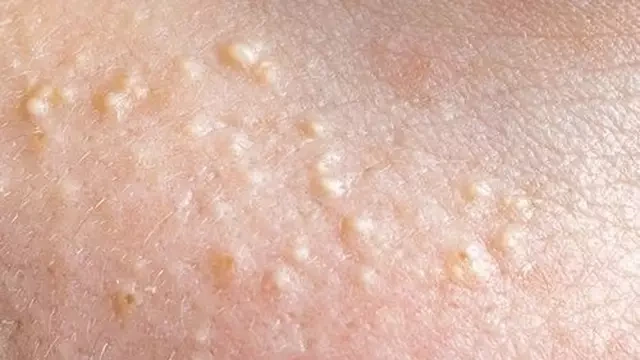 People issued major warning if they have series of white spots on body including private parts