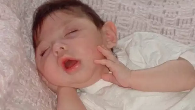 Hydranencephaly explained as woman born with no brain celebrates 20th birthday.