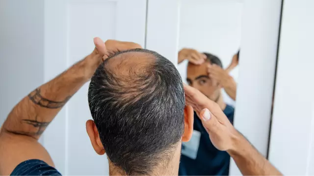 Scientists discover breakthrough ‘cure’ for hair loss which takes just 20 days.