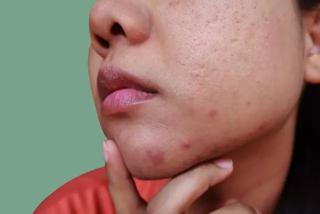 But you really shouldn't 'mess around' with cystic acne, according to Dr Ellis