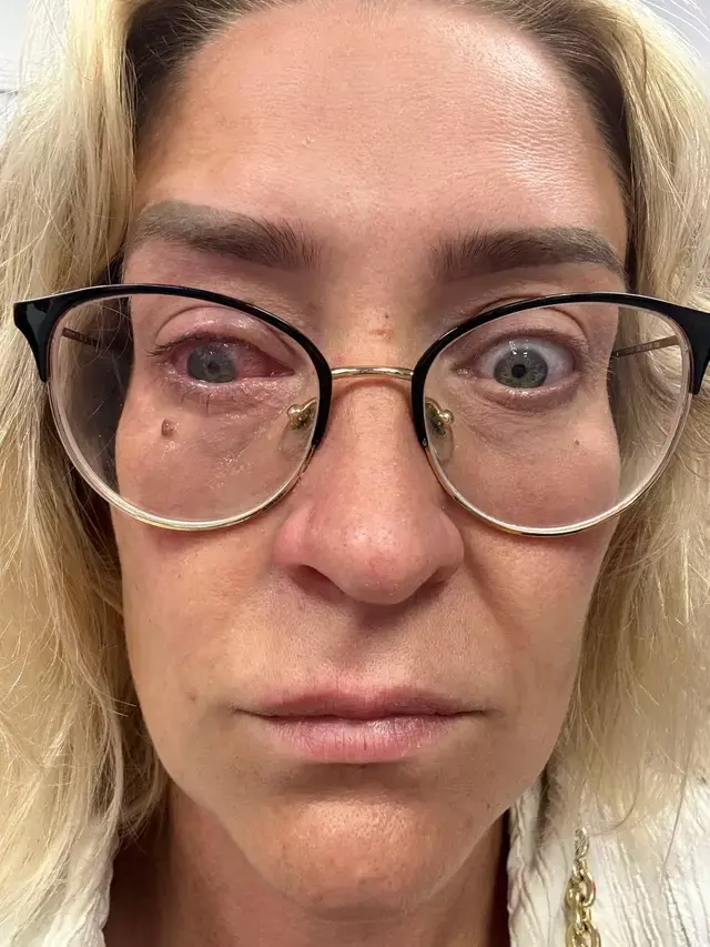 Katie lost the vision in her right eye 